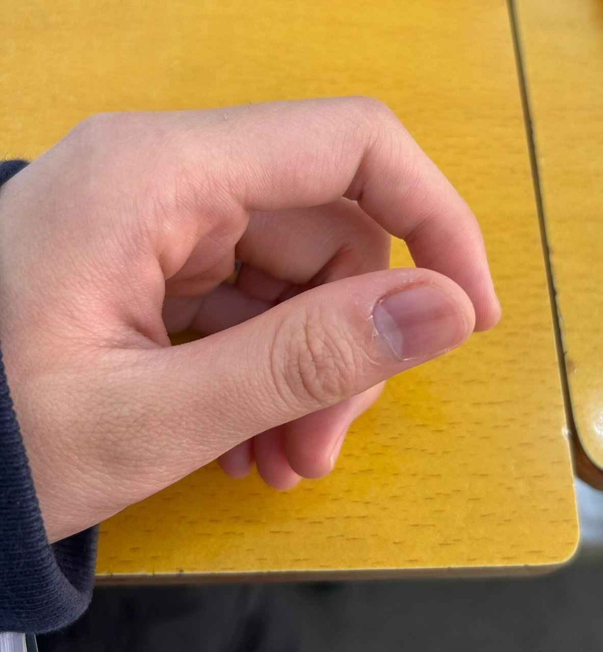 指甲上有一条黑线 左手大拇指长了条黑线半年多了 没有受伤 也不是