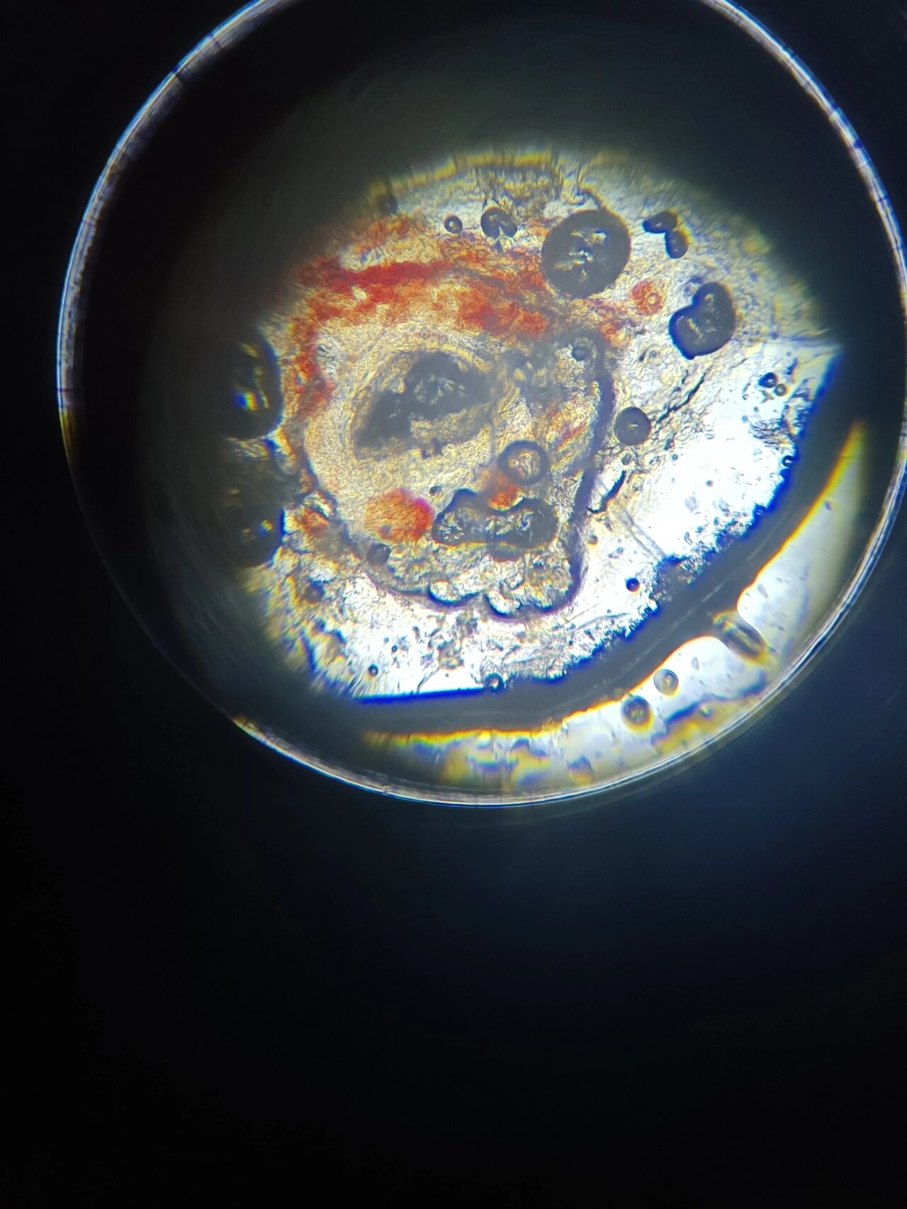 显微镜下的黑头粉刺 青春期女生的噩梦