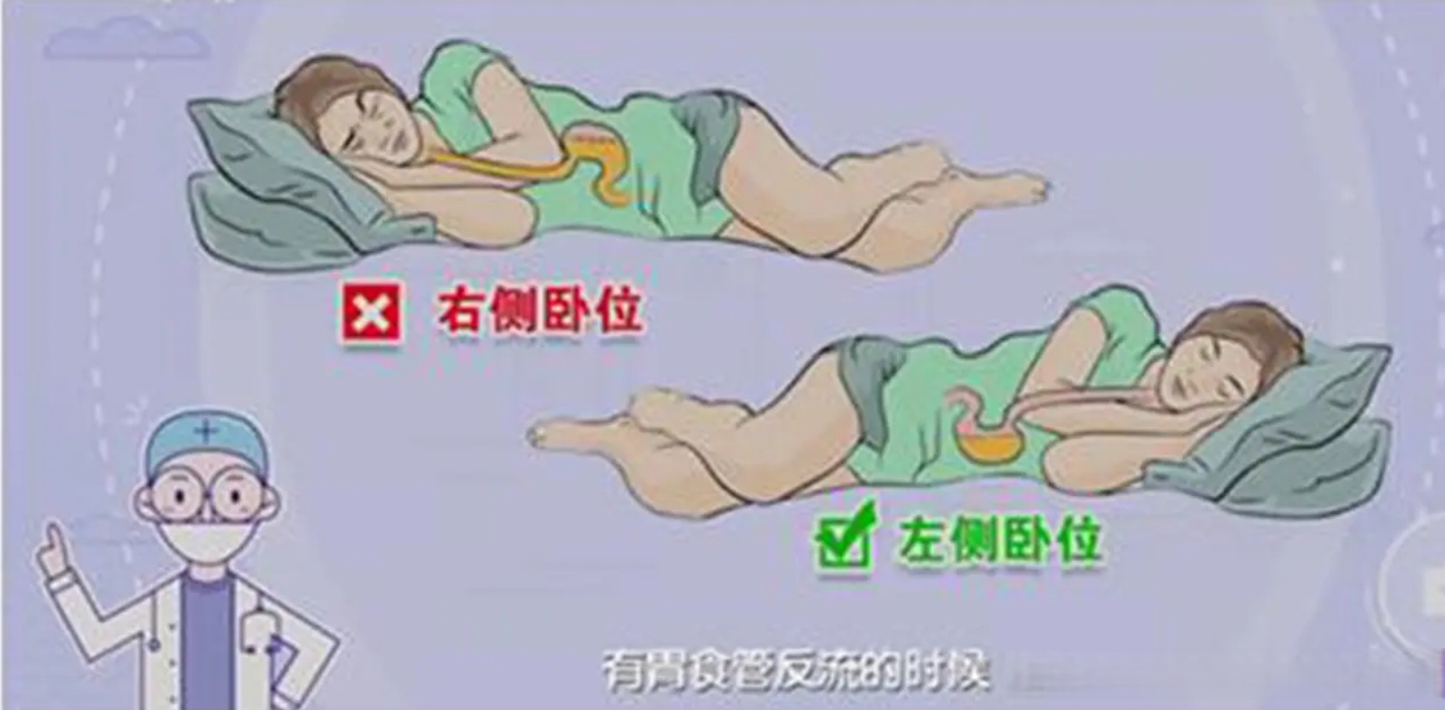 肠粘连正确睡姿图片食管反流三个睡姿图右侧卧位胃的图片胆汁反流睡姿
