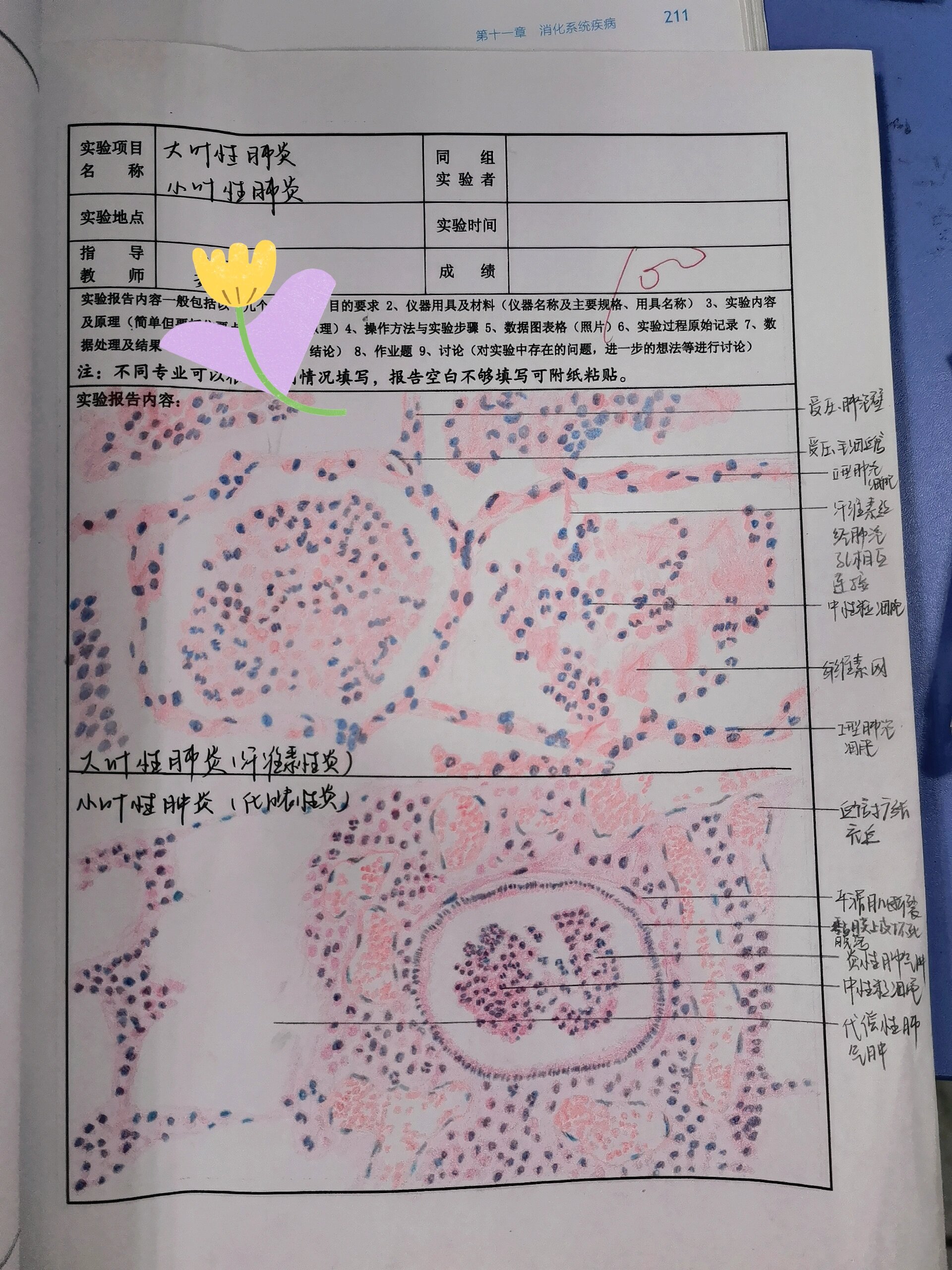 大叶性肺炎手绘图图片