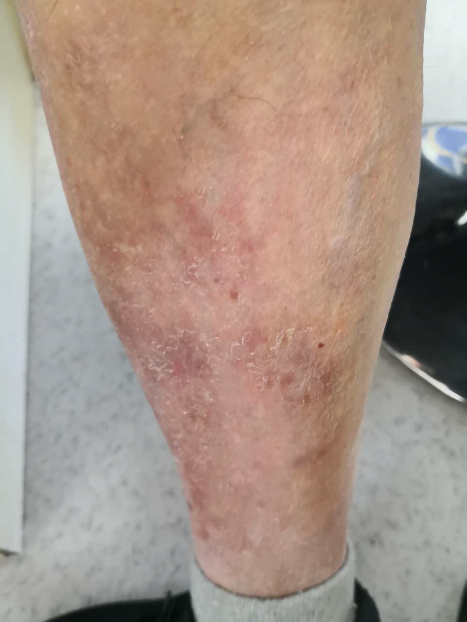 小腿部位干燥脱屑症状.乏脂性湿疹