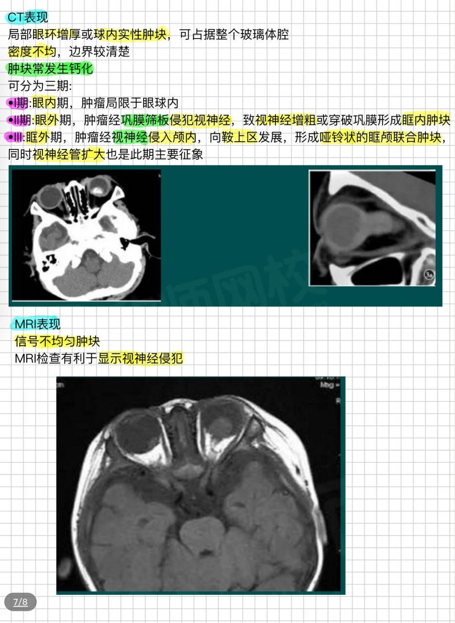 脉络膜黑色素瘤转移图片