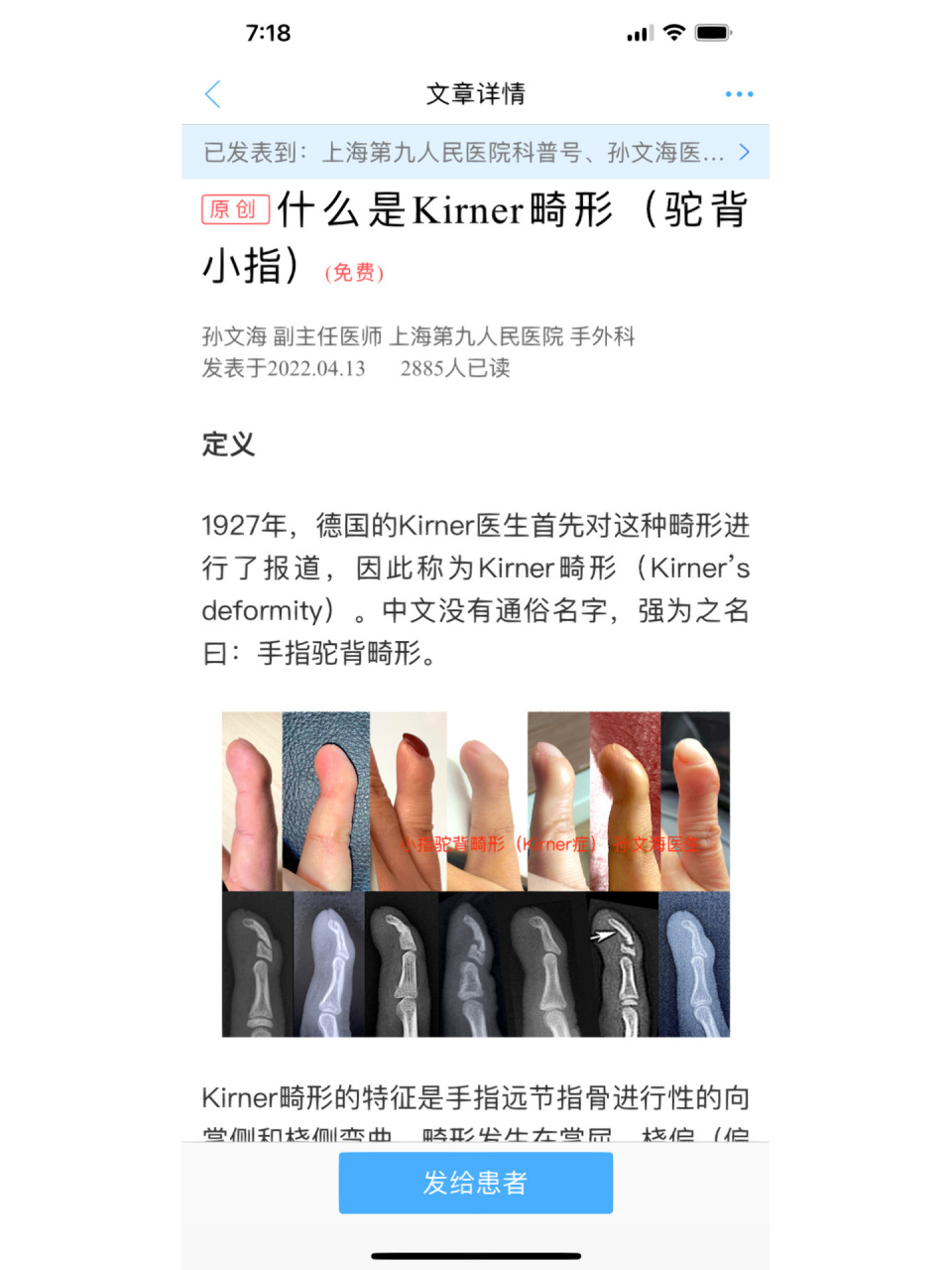 小指驼背伸不直,原来是kirner症    kirner畸形(驼背小指)和a3型短指