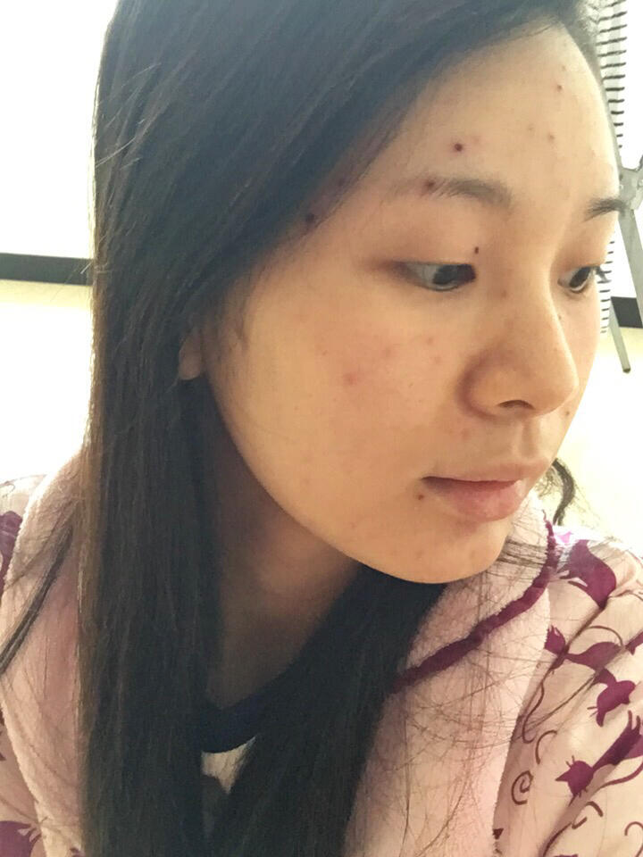 脸上结痂怎么回事水痘结疤的样子图片水痘几天能好水痘正常掉痂的照片
