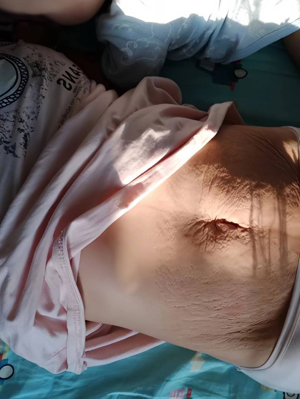 怀孕的时候没好好打理妊娠纹.