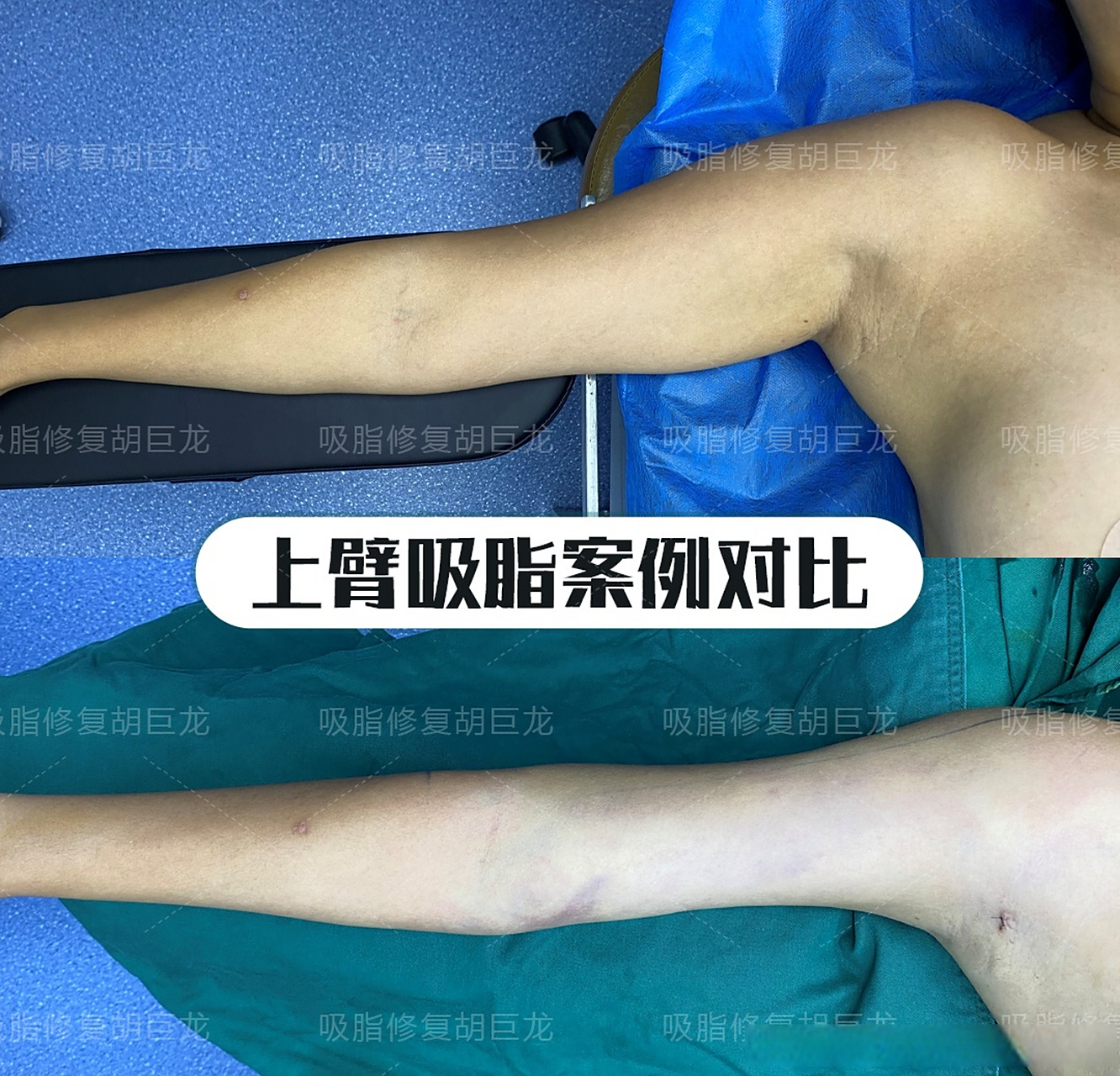 宝丽太手臂吸脂,副乳术后即刻对比案例  夏天快来了,发现大家对于手臂