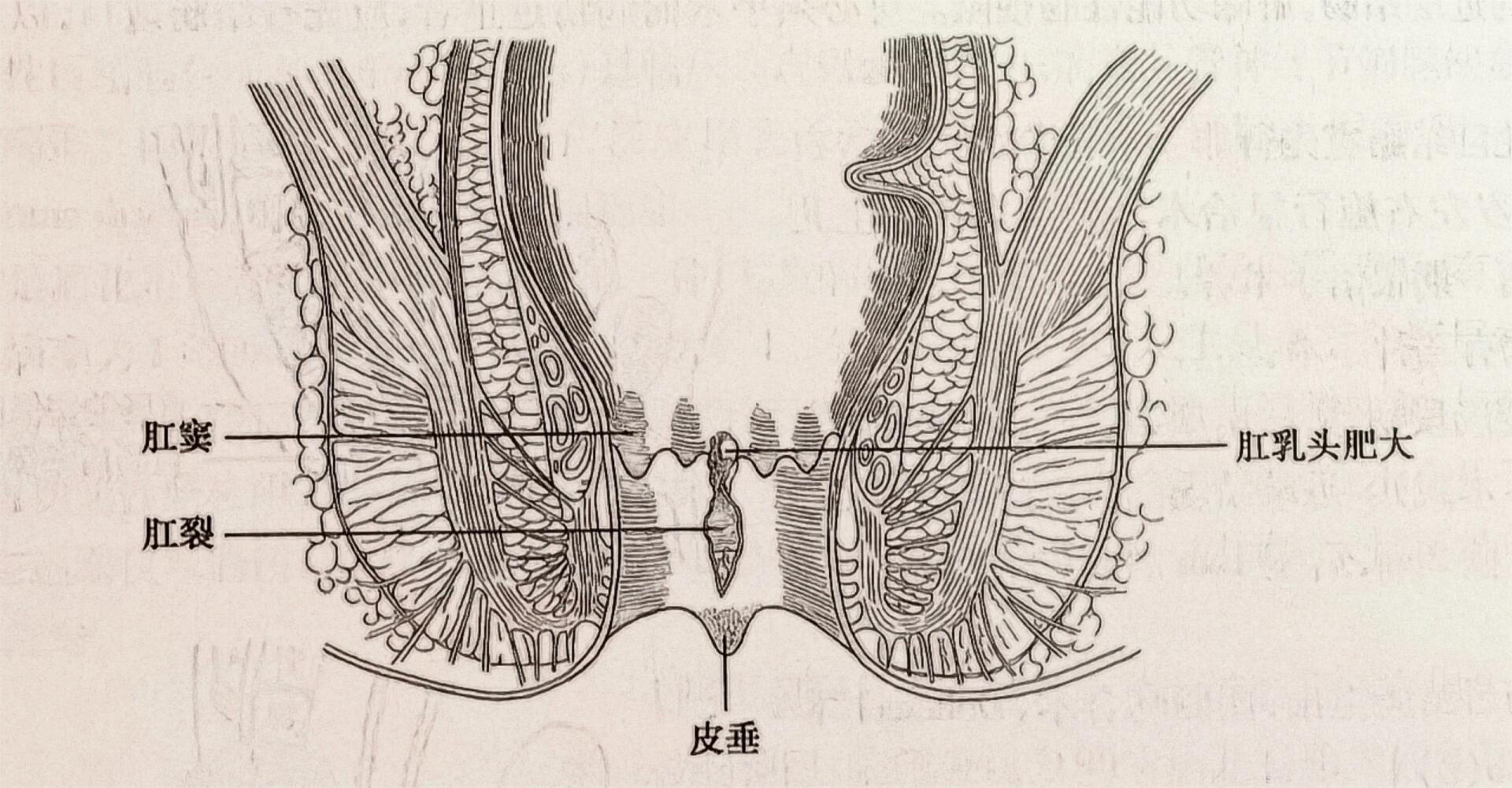 肛乳头肥大是什么东西图片