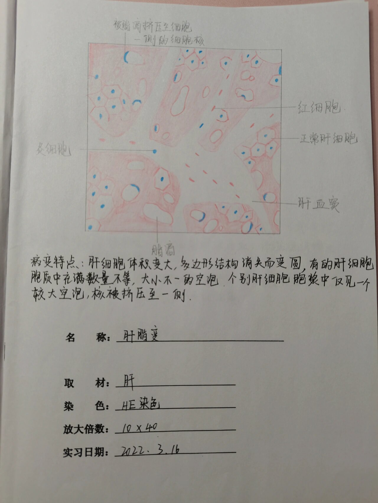 肝细胞脂肪变红蓝图片