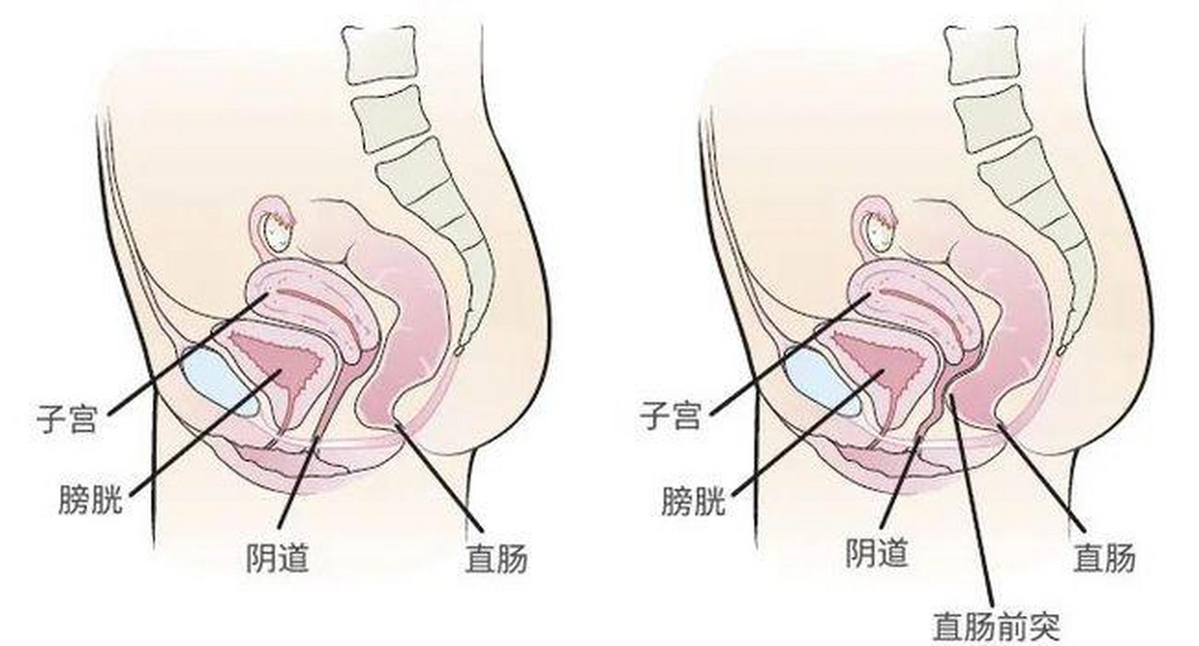 一般来说,有直肠前突便秘的患者,他们都有一个什么样的体验呢?