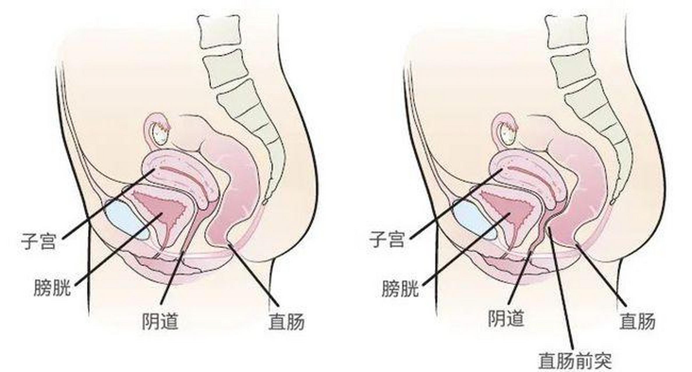 直肠前突最佳治疗方法图片