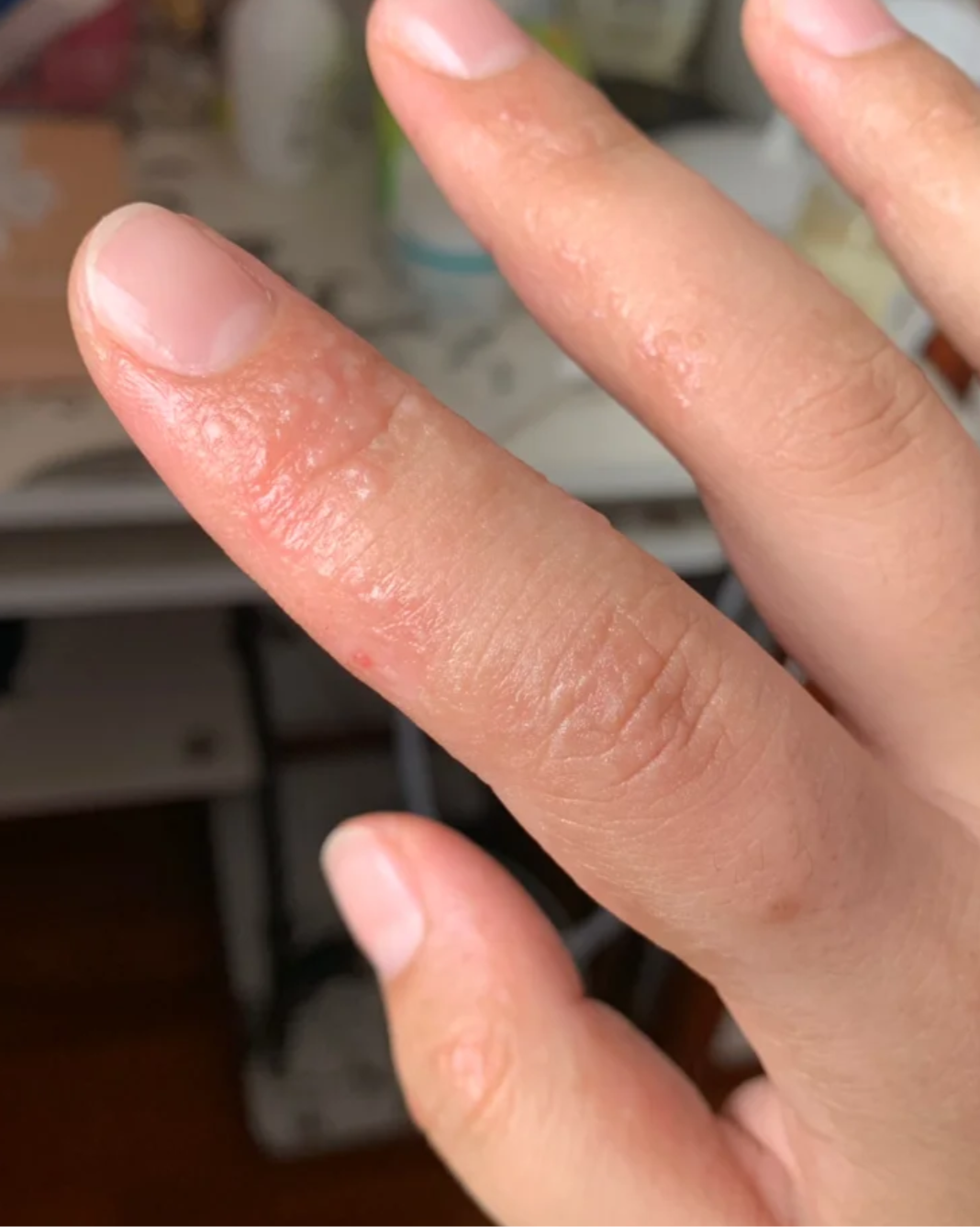 手指关节长小痘痘还发痒,常见原因有湿疹,接触性皮炎,病毒疣和手. 