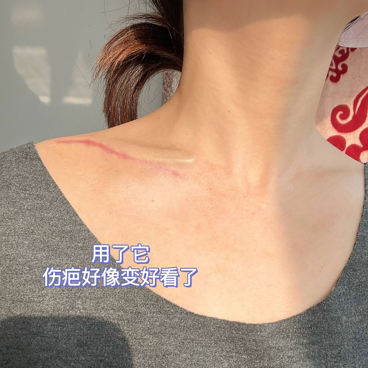 锁骨骨折术后71天|刀口伤疤可以涂碘伏护理  伤筋动骨100天 今天是