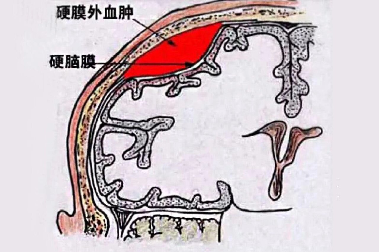 梭形血肿图片