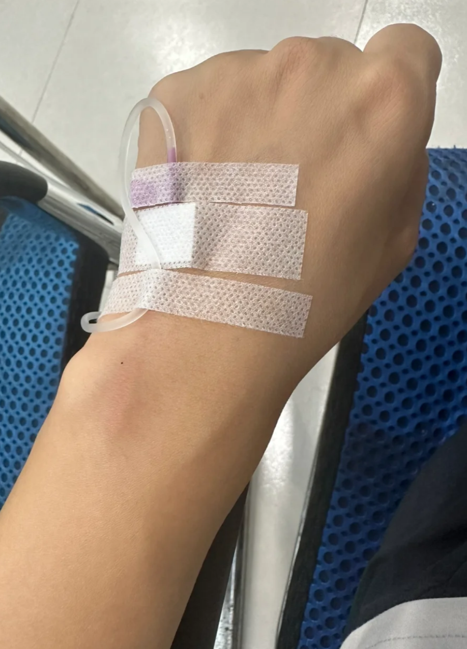 疱疹是否需要输液要看病情严重程度