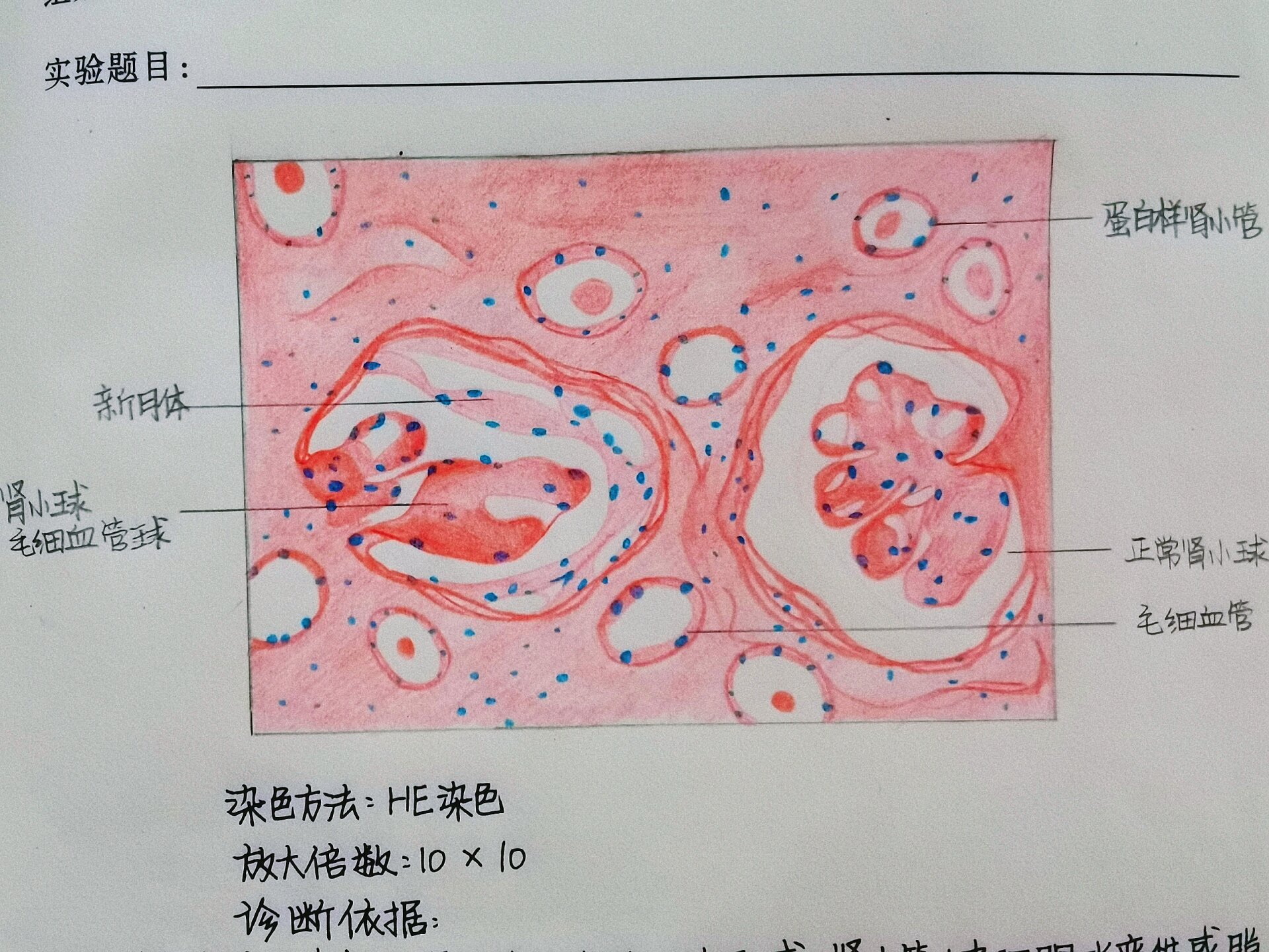 新月体性肾小球肾炎图片