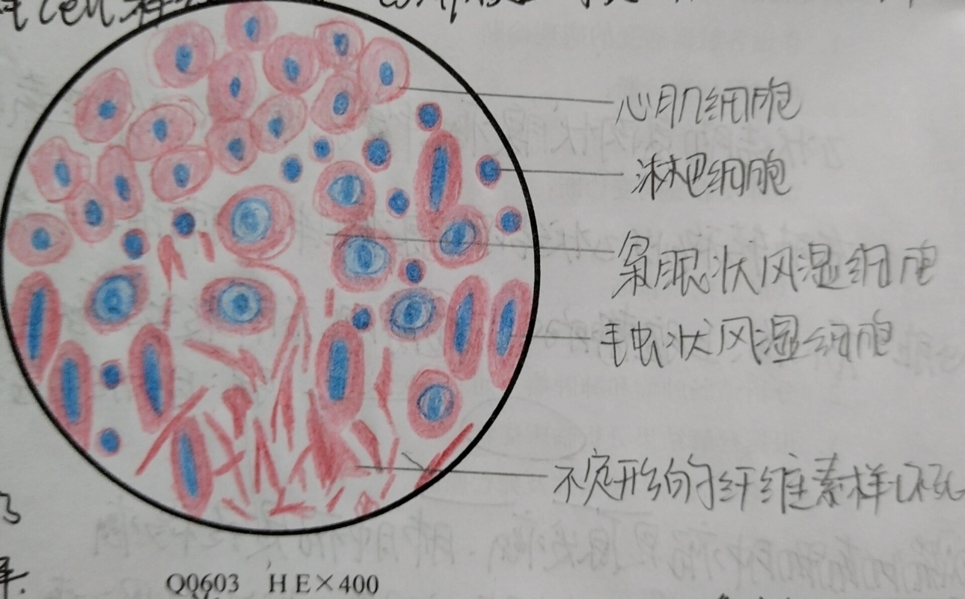 风湿性心肌炎病理图片