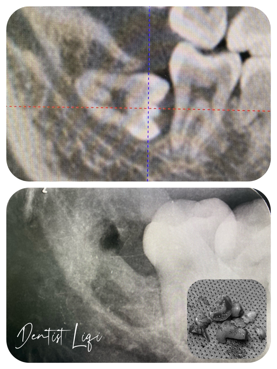 完全"躺"在神经管上的低位骨埋伏阻生智齿 难点在于分牙分根时对神经