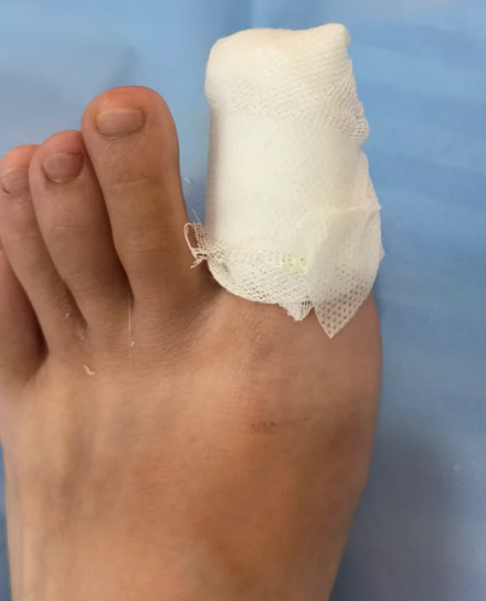 脚趾甲踢到门上导致甲床分离时,先别慌,按步骤处理就行
