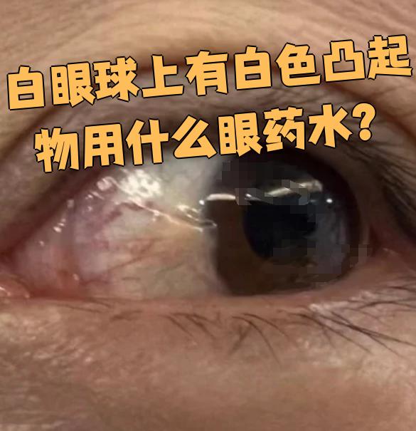 如果是滤泡性结膜炎,眼睛可能发红,发痒或有异物感