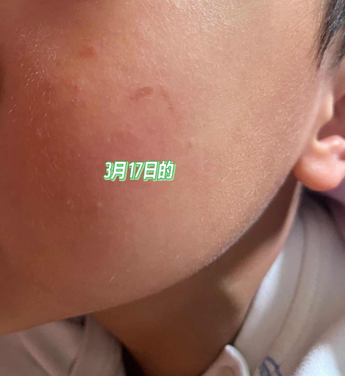 1月10日被指甲抓伤 没做任何处理,平时擦点霜,2个月了还没恢复,有点