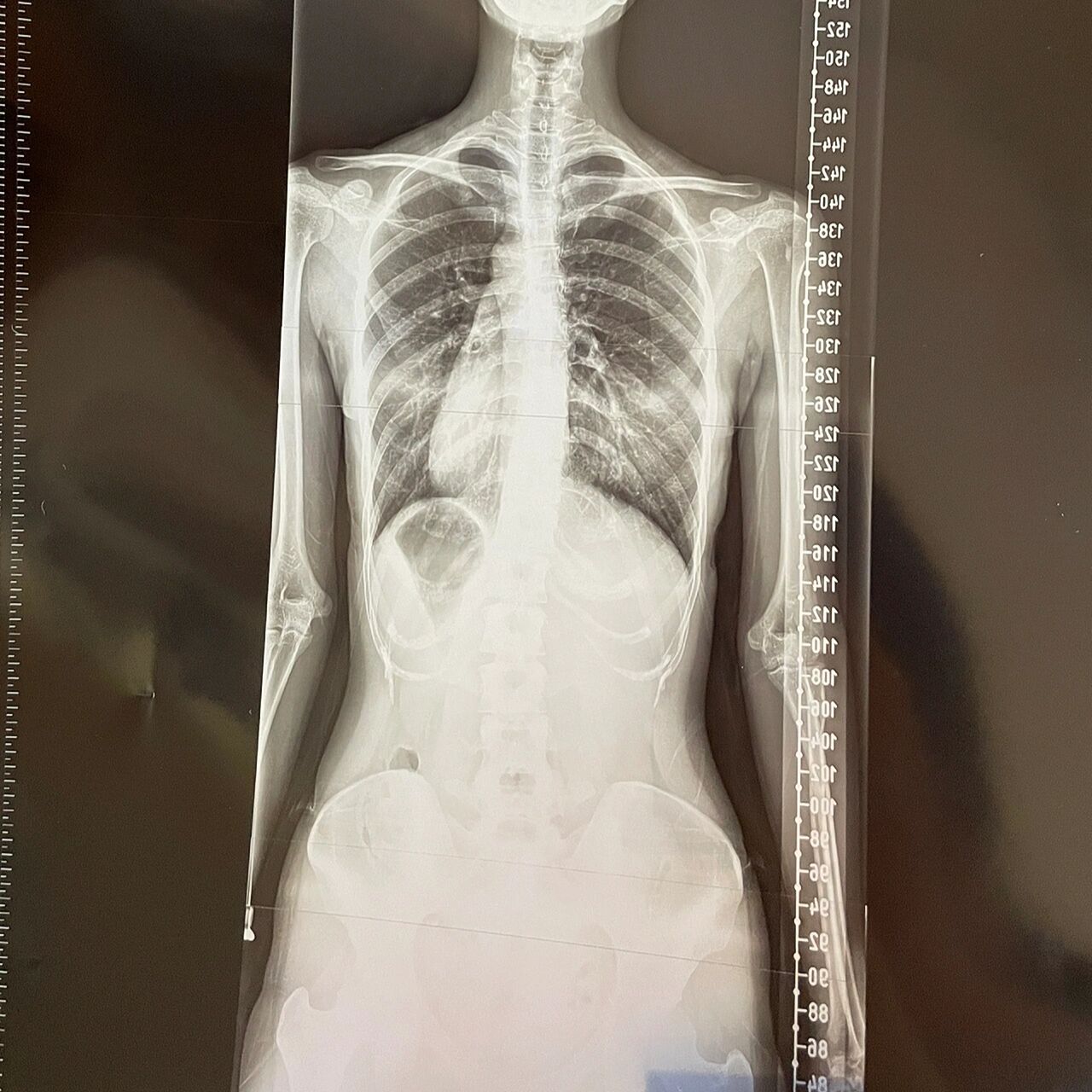 脊柱侧弯 腰线不对称,走路走久了腰会很疼,坐久了会背疼  	 以下补充