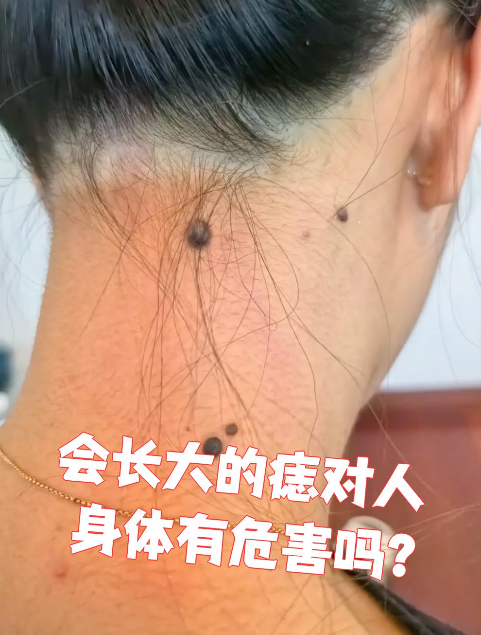 为什么身上会长痣呢为什么在线 为什么身上会长痣呢为什么在线