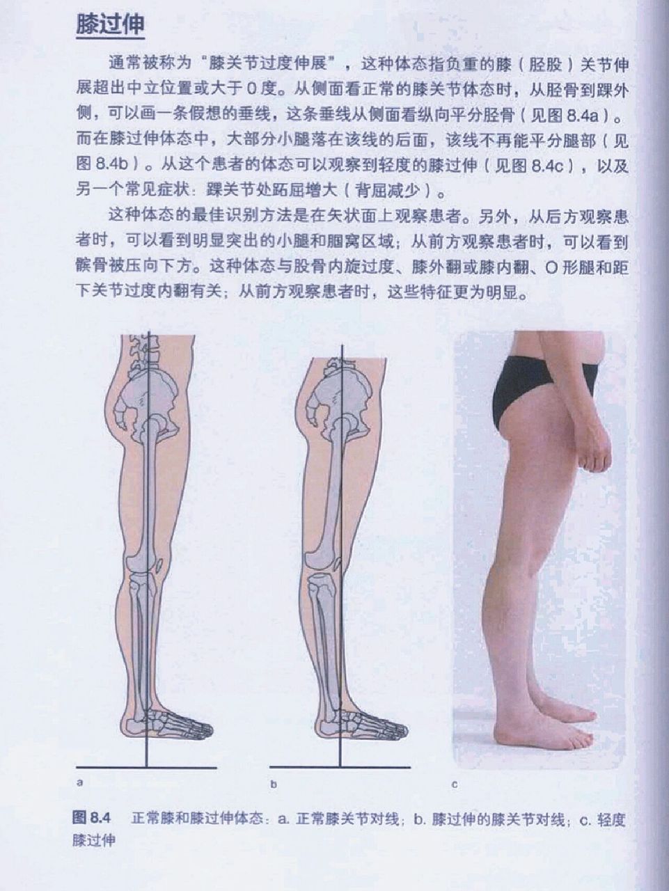 膝超伸→骨盆前倾(前移) 1:在有膝超伸的情况下还附加xo型腿,会加速膝