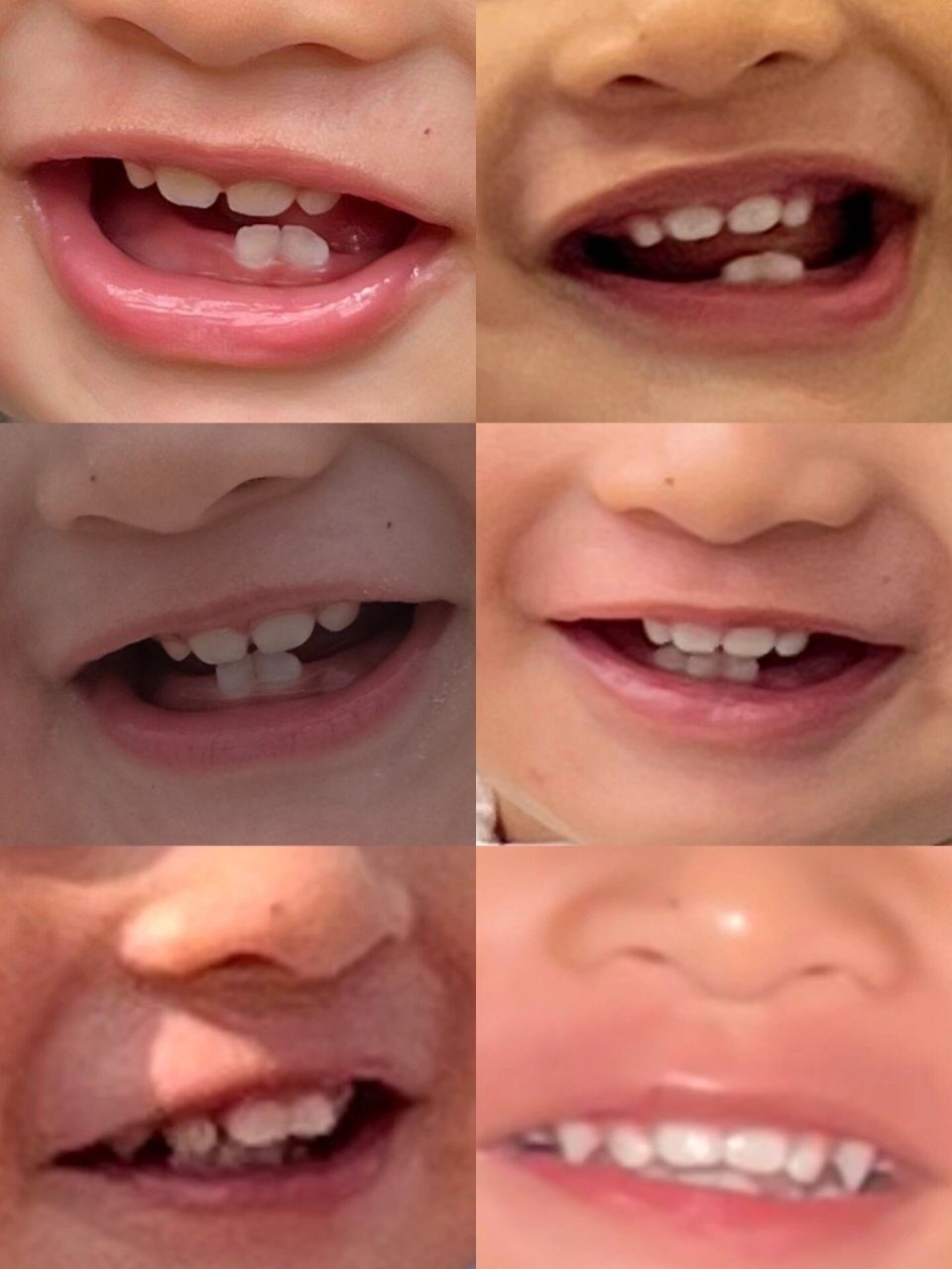 小孩吸奶嘴牙齿变形图图片