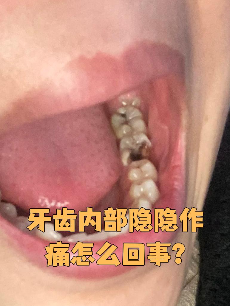 牙齿内部隐隐作痛常见原因有三个:深龋,慢性牙髓炎和冠周炎