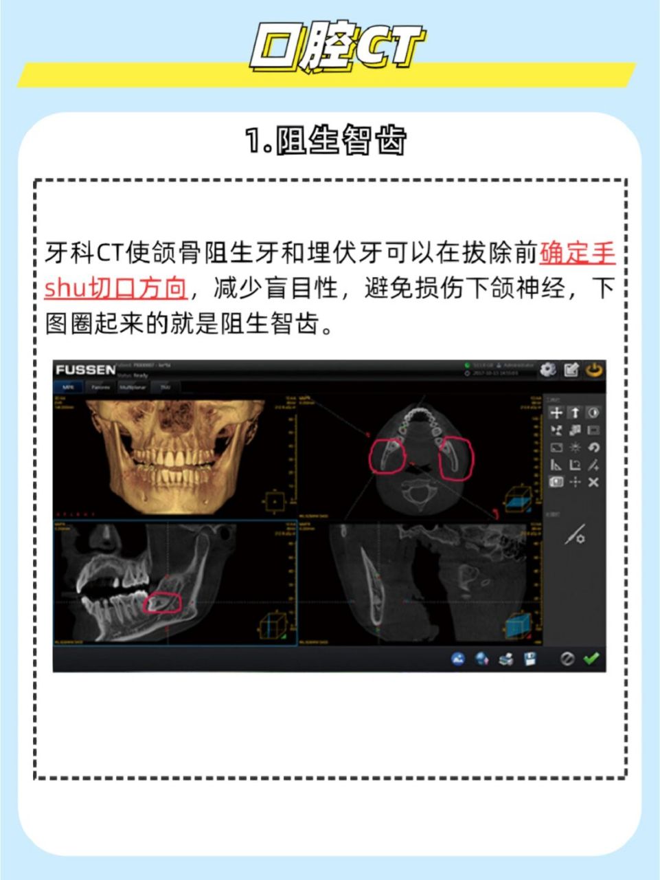 智齿ct图解析图片