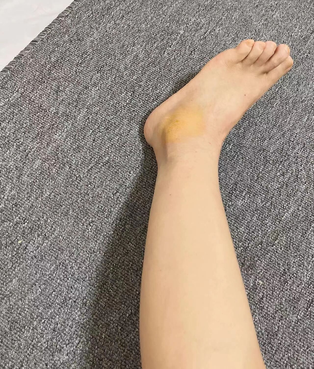 崴脚的第37天,不肿了
