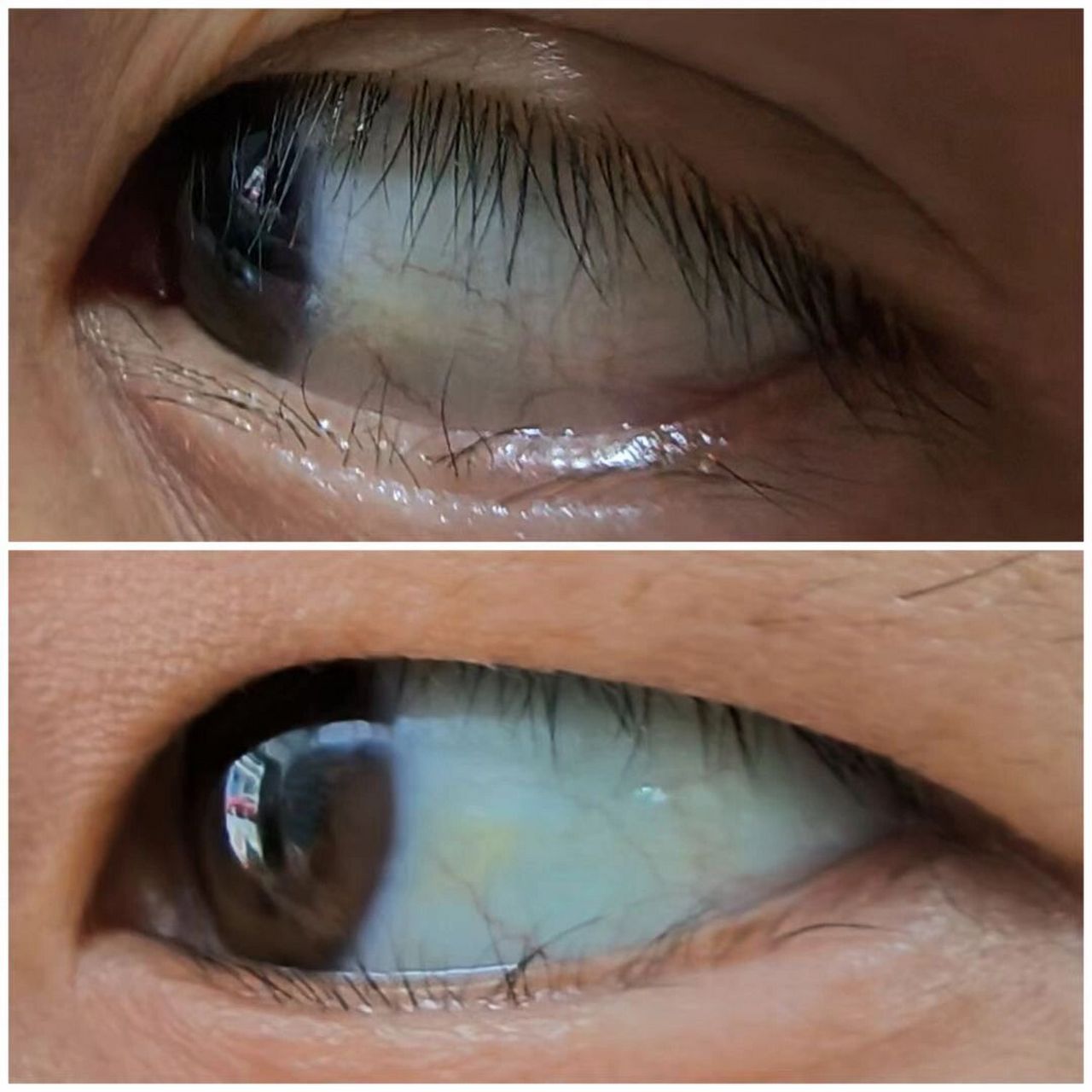 黄斑变性是指眼睛黄斑长期过度的劳累导致了脉络膜血管硬化,黄斑区 