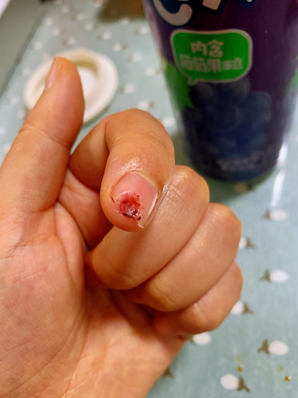 菜刀切了手指伤口大约几天能好 一周前菜刀切了手指,指甲以及甲下的肉