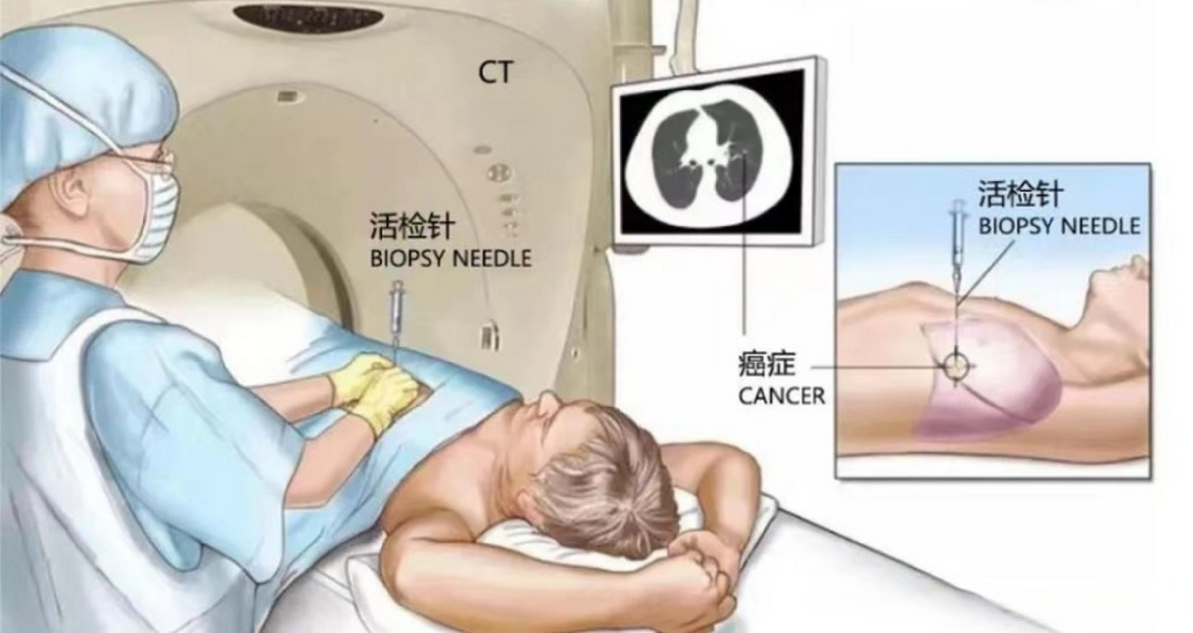 "针"相大白----ct引导下经皮肺穿刺活检术肺癌#  近年来,随着体检肺