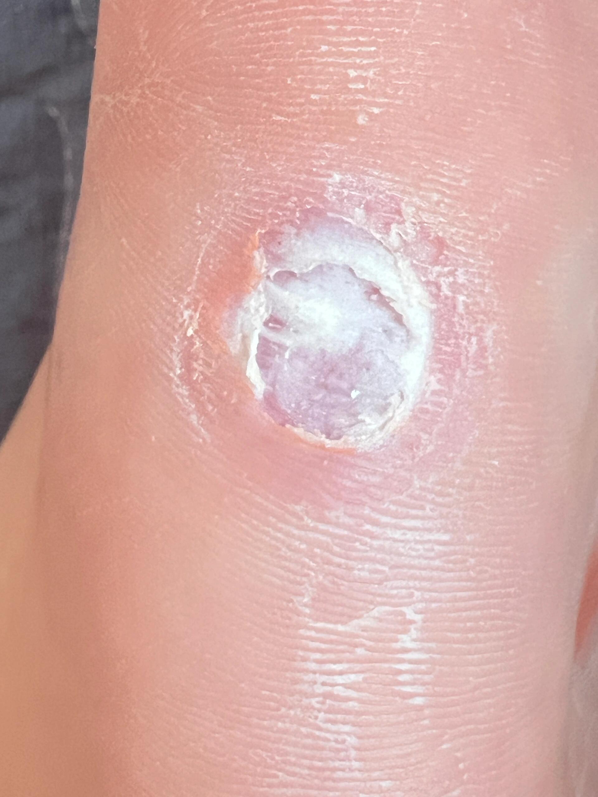 鸡眼问题🙋 这是算好了吗鸡眼?我把白色腐肉刮没了.不想贴药了