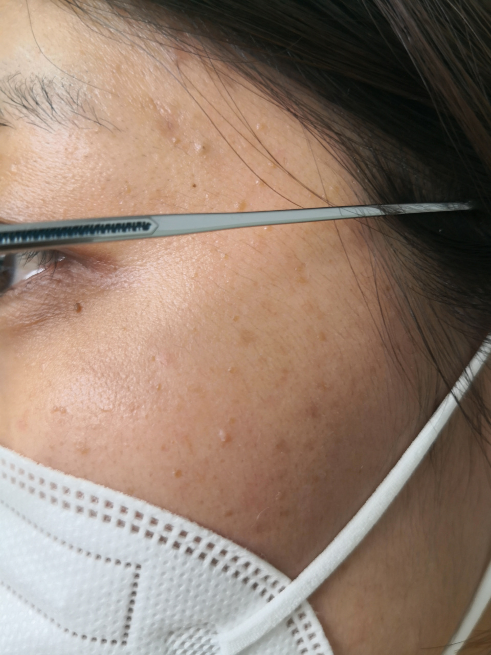 寻常疣##老年斑##脂溢性角化##解决皮肤问题专注皮肤美容