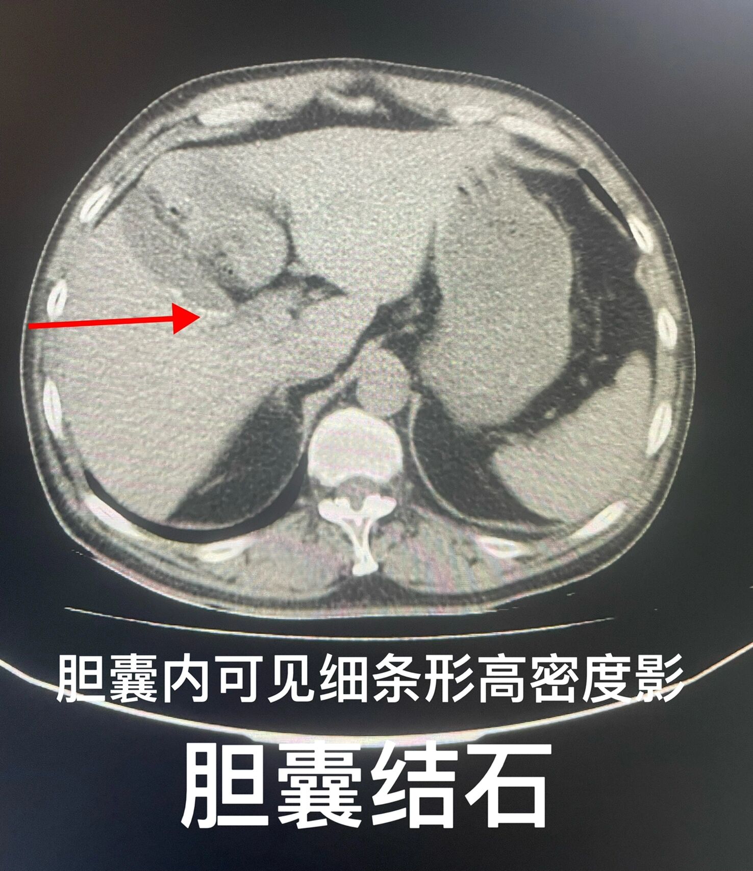 胆总管ct正常图解图片