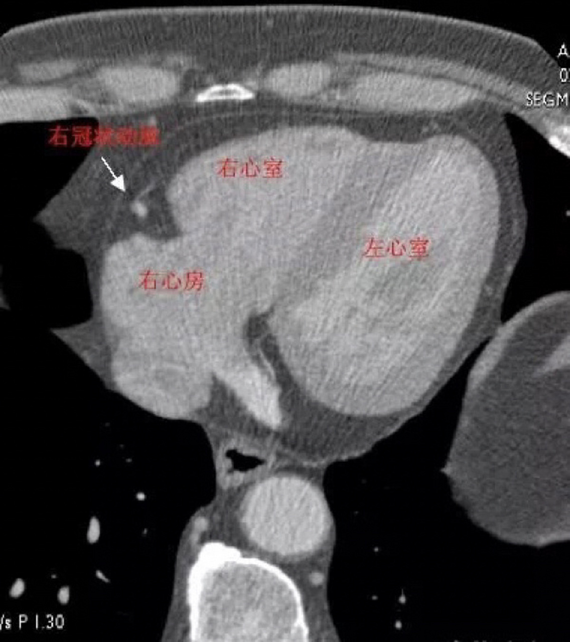 冠状动脉ct片子图片图片