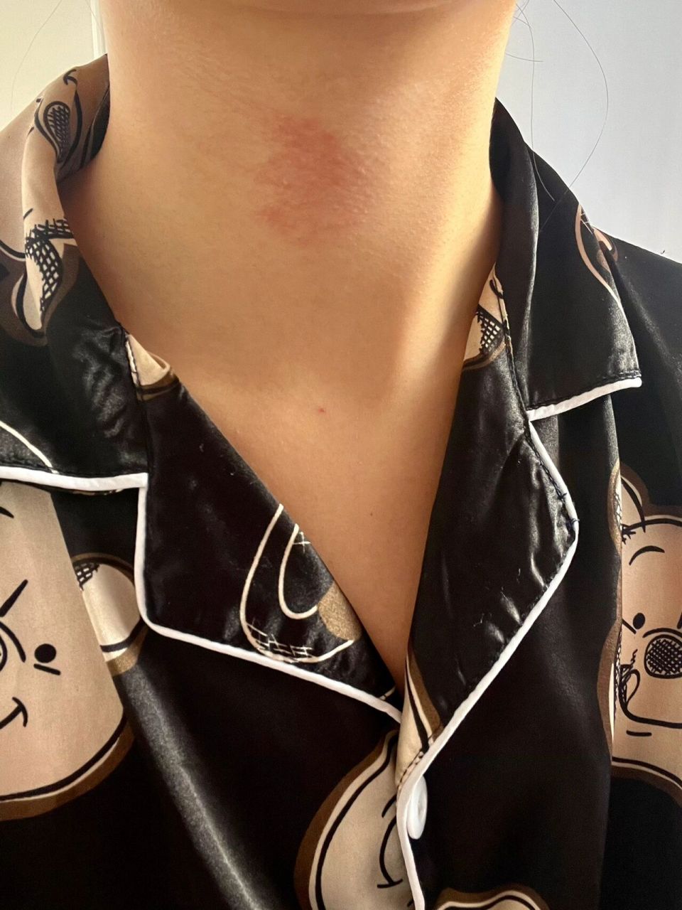 有姐妹知道脖子上反复长得这个红一片的东西是什么吗,很痒,然后抹了