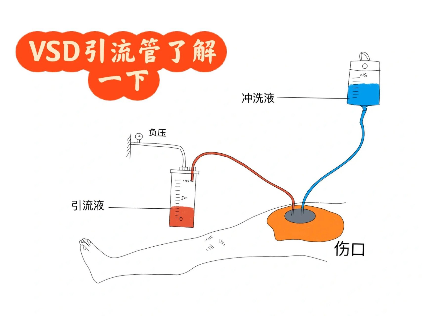 负压封闭引流技术(vacuum sealing drainage 负压封闭引流技术(vacuum