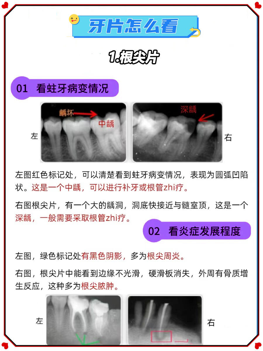 牙齿拍片解析图图片