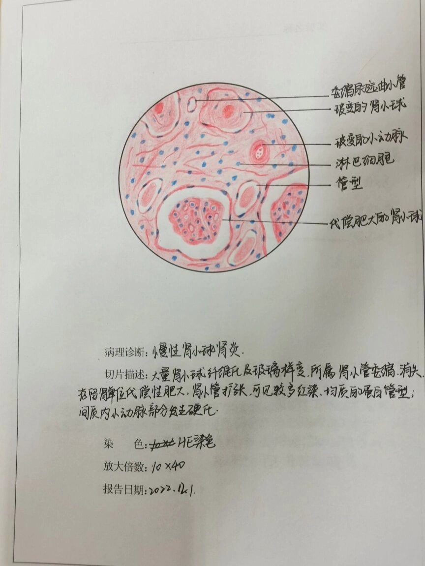 门脉性肝硬化 红蓝图片