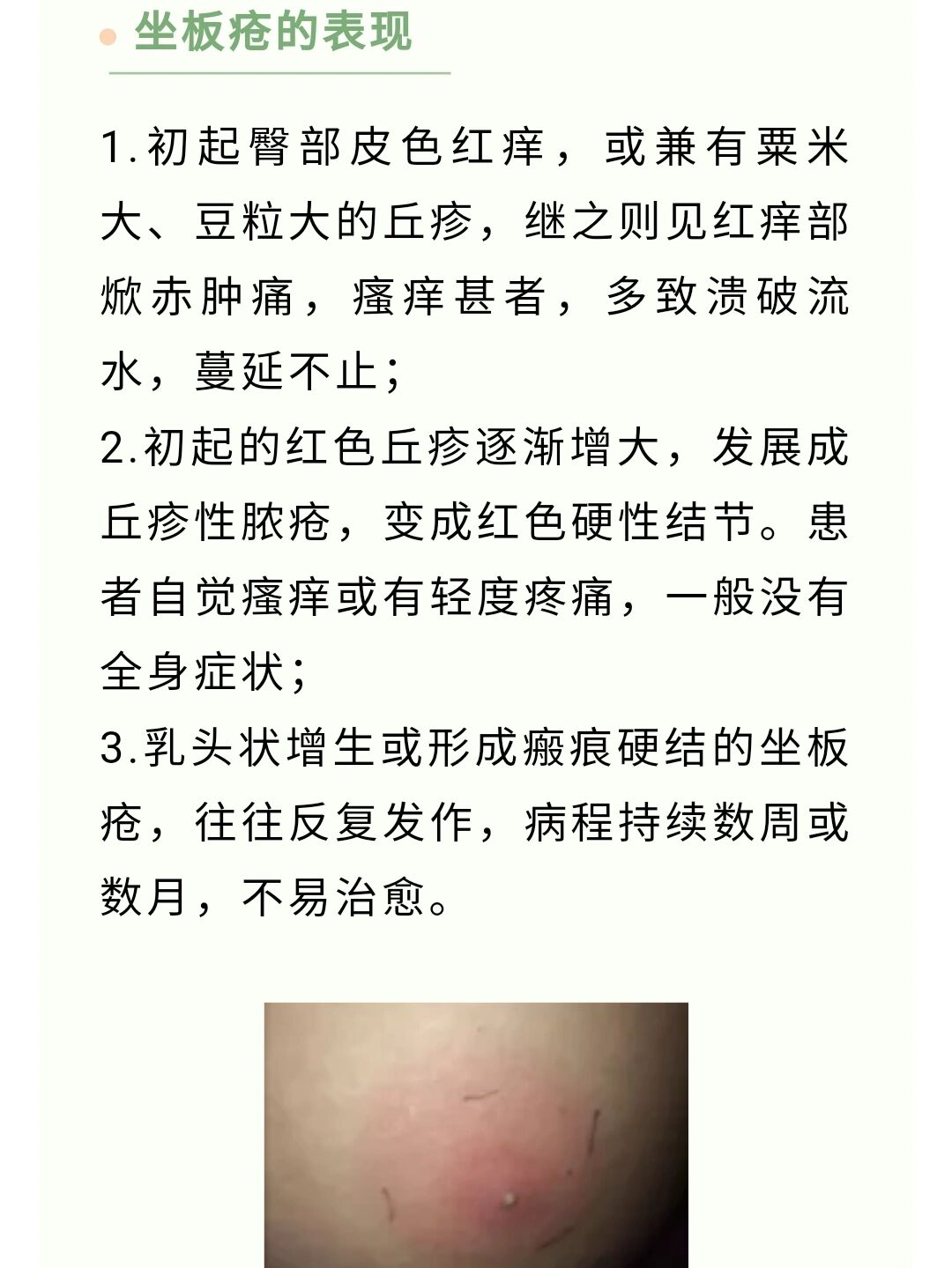 坐板疮