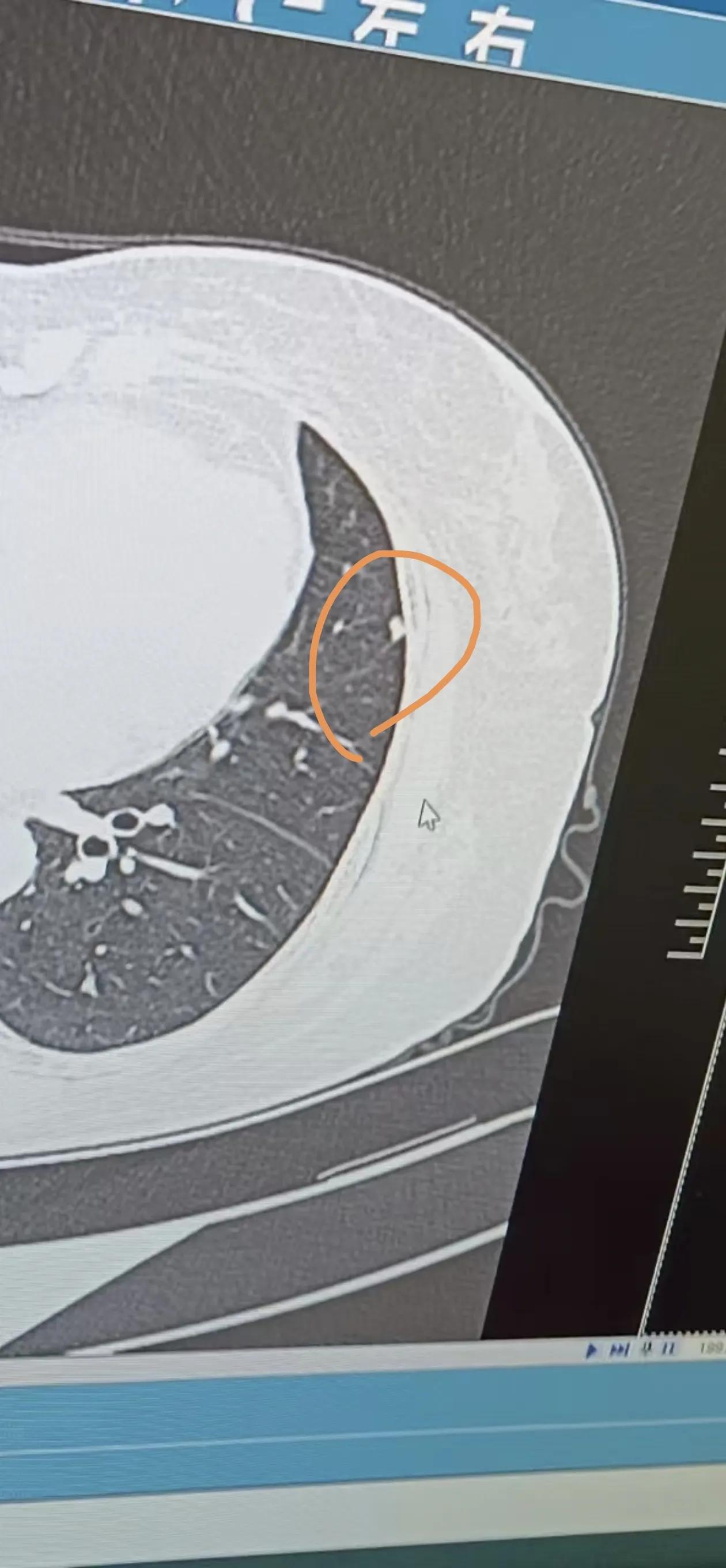 肺结节99%以上不用处理 只有那些合并 毛刺征 血管征 胸膜牵拉征 动态