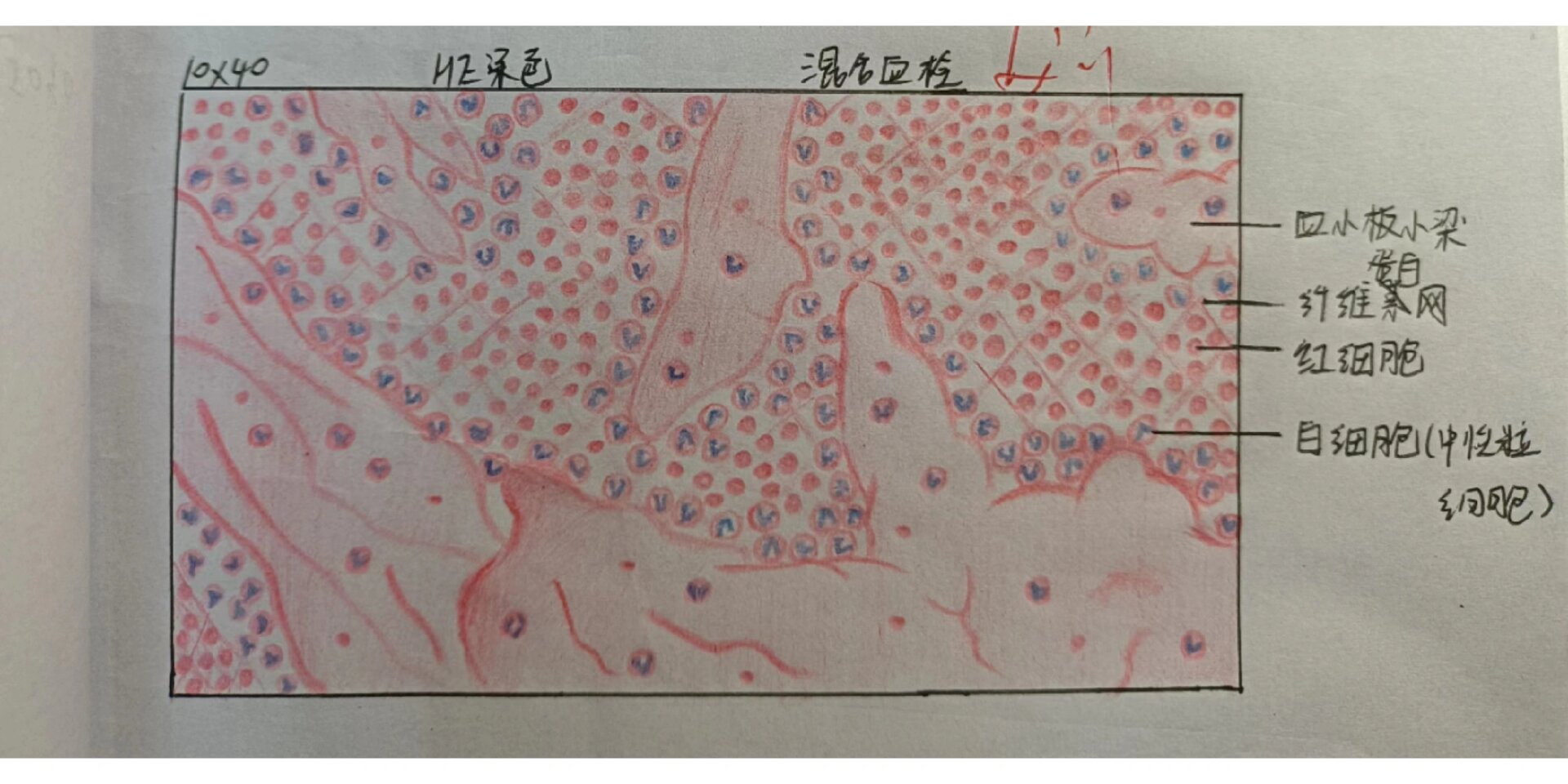 病理绘图 混合血栓 病理绘图 混合血栓来啦