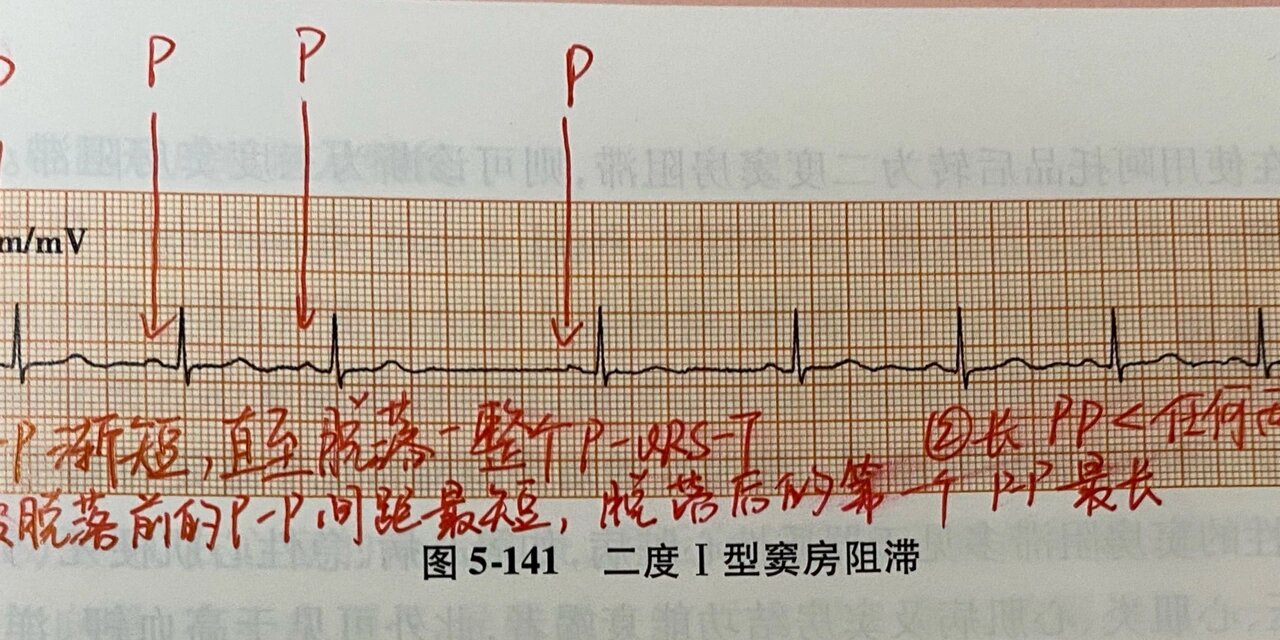 简易心电图