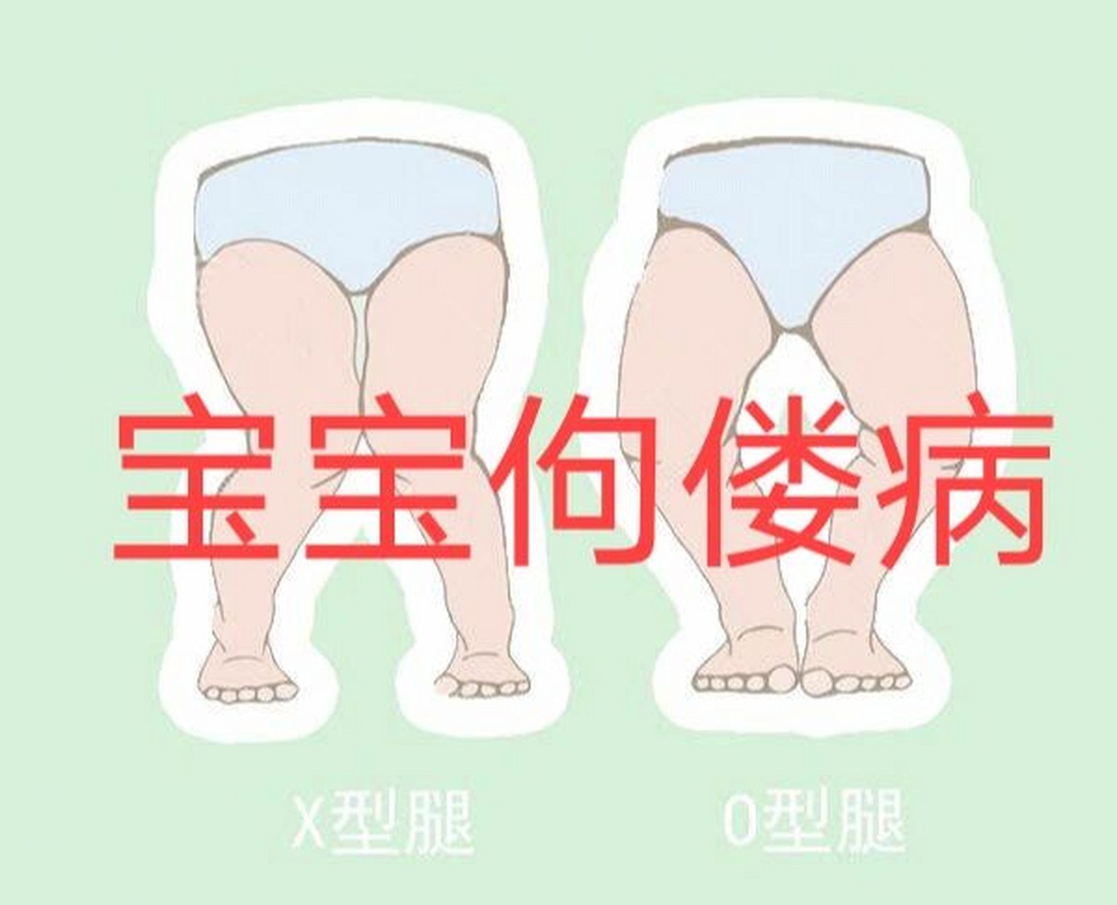 警惕,宝宝以下症状也可能是佝偻病 一说到佝偻病,大家首先想到的就是