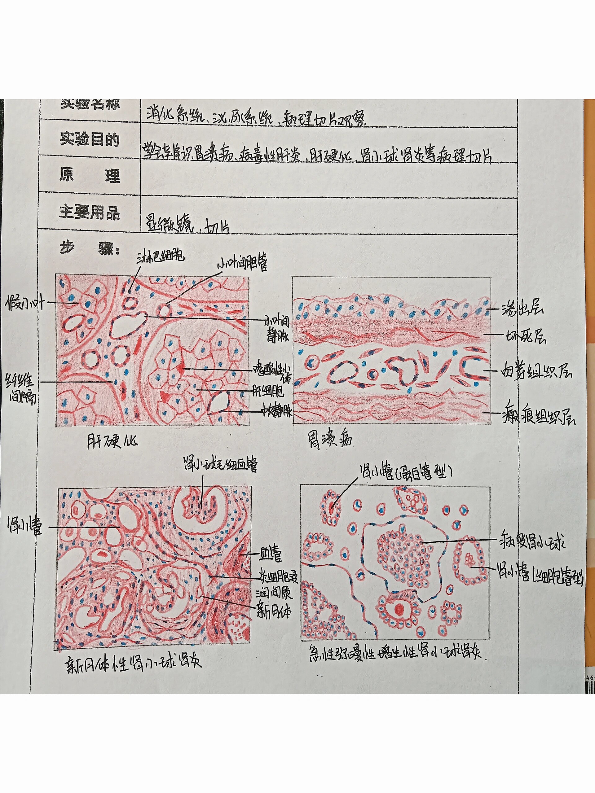 化脓性肾炎切片图片