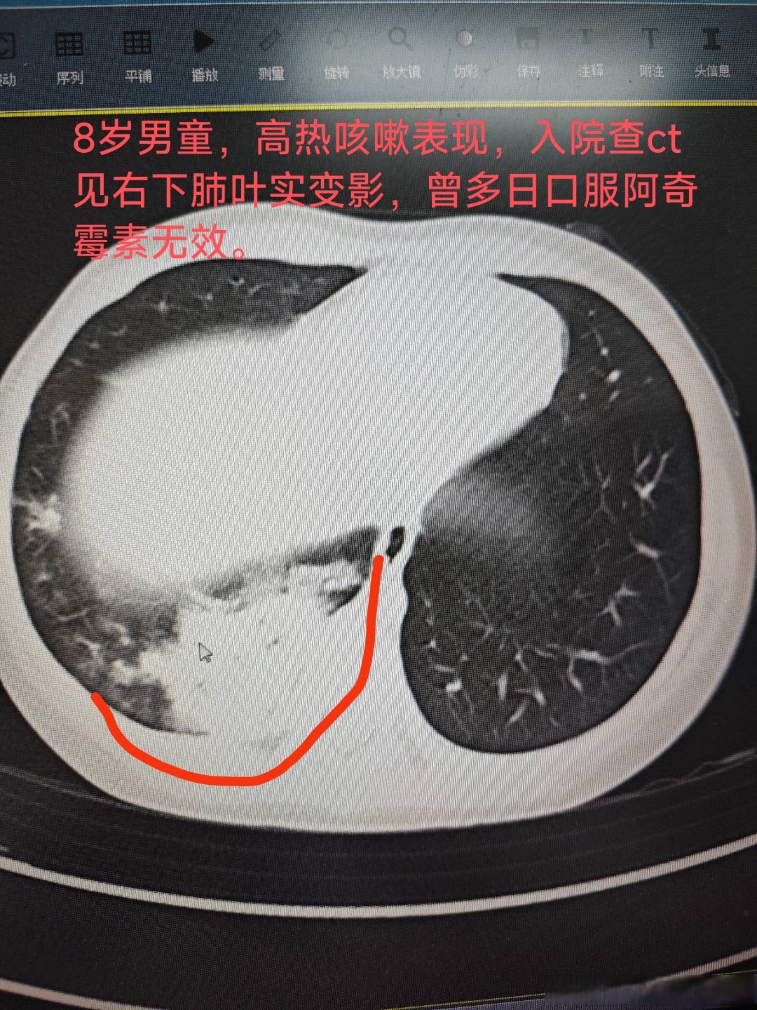 8岁男童大叶性肺炎,肺实变,应用阿奇霉素无效,可遵