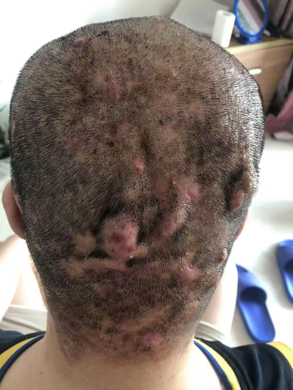 穿掘性毛囊炎满头长大脓包,是直接开刀手术,还是中药保守治疗?